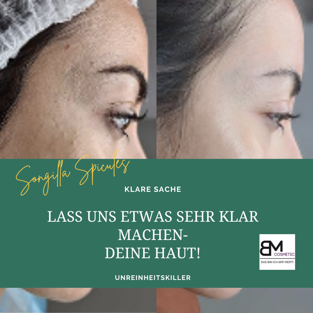 SQT Biomicroneedling Starterset Akne inkl. online Schulung