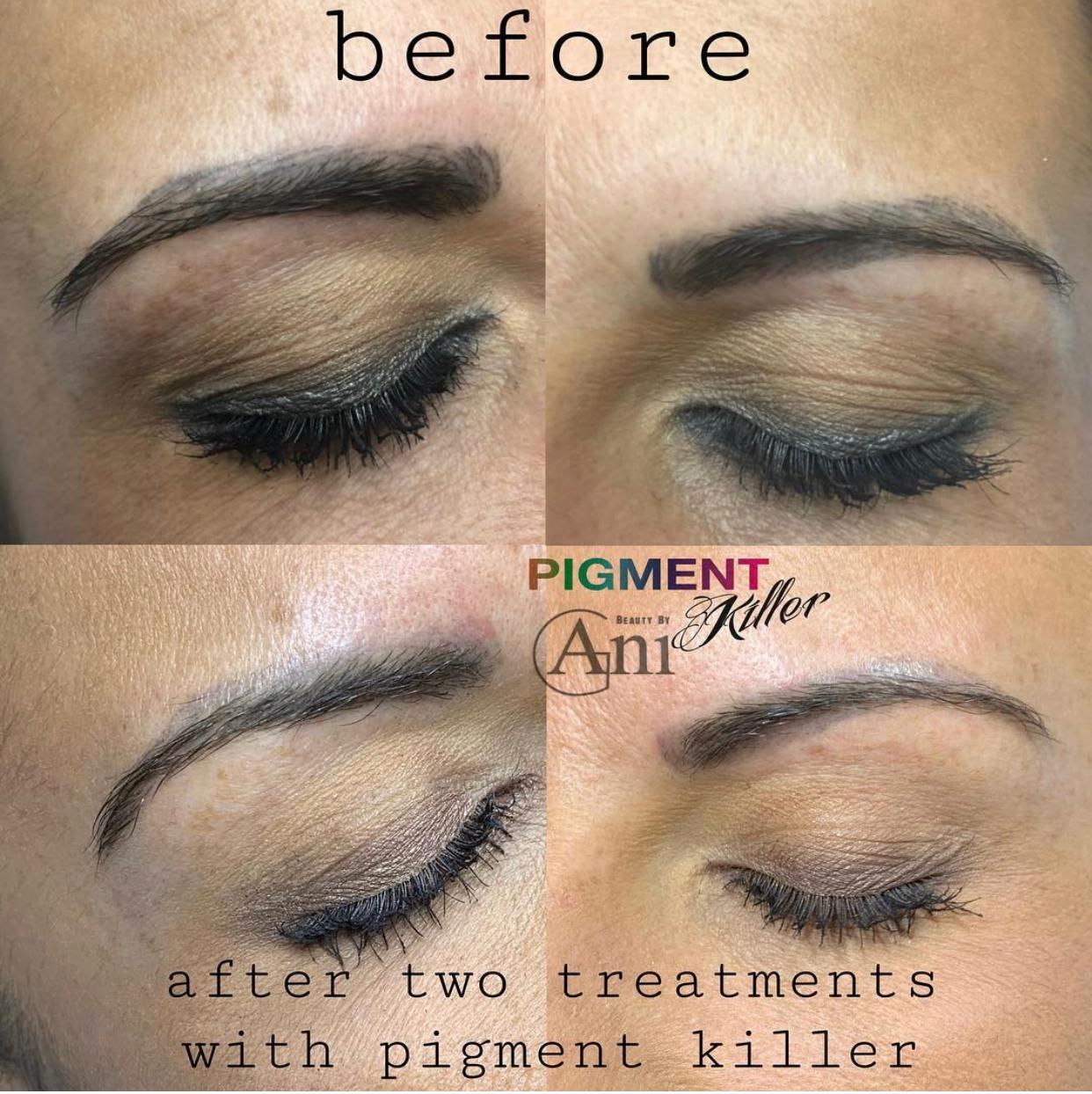 Pigmentkiller-Bundle inkl. Online Schulung