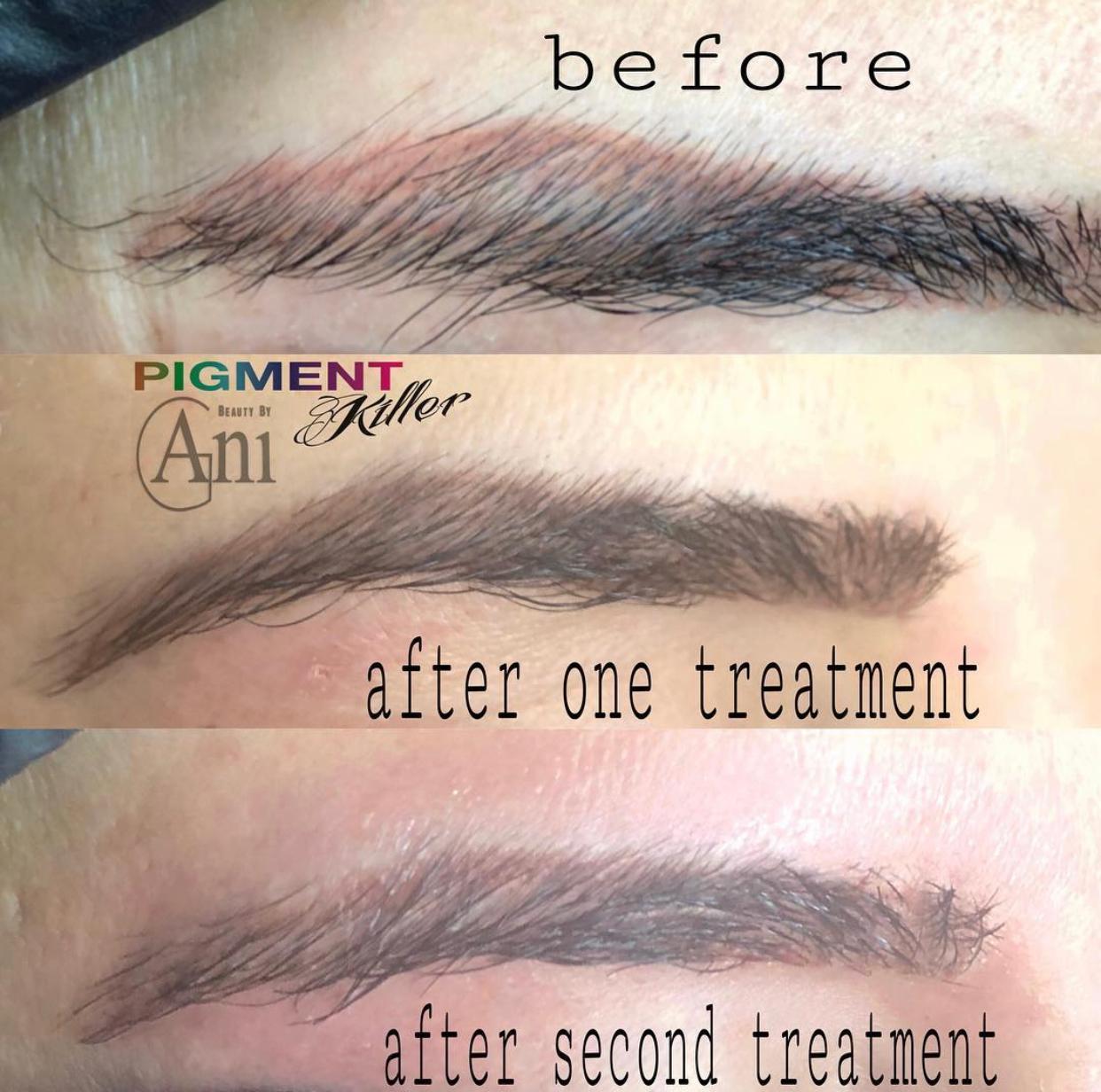 Pigmentkiller-Bundle inkl. Online Schulung