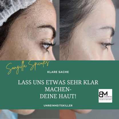 SQT Biomicroneedling Starterset Akne inkl. online Schulung